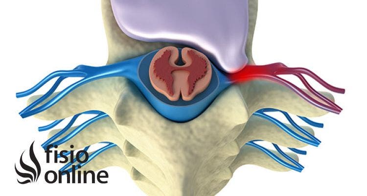 Lumbares tipos discales de hernias